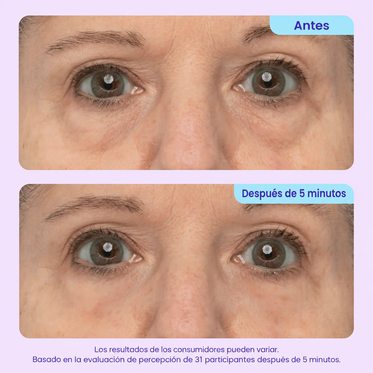 ¡DILE ADIOS A ESAS BOLSAS QUE ARUINAN TU ROSTRO! - TRATAMIENTO PROFESIONAL EFECTO LIFTHING - 60%OFF