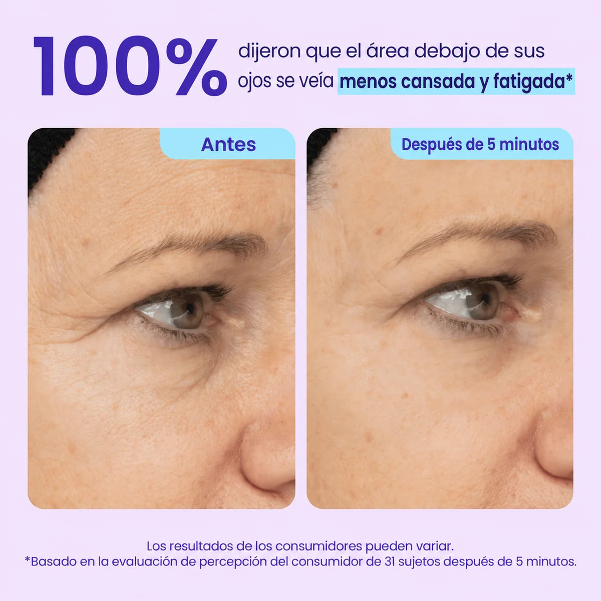 ¡DILE ADIOS A ESAS BOLSAS QUE ARUINAN TU ROSTRO! - TRATAMIENTO PROFESIONAL EFECTO LIFTHING - 60%OFF